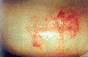 褥疮的前兆有什么