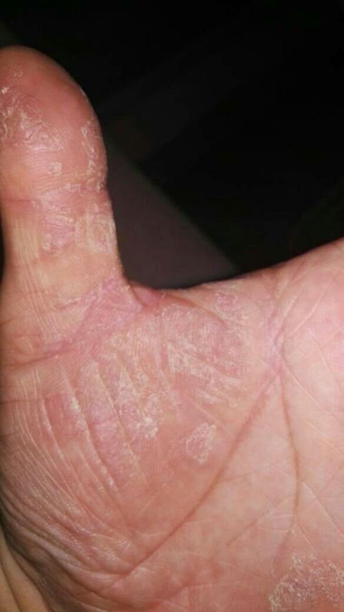 有的说是鹅掌风,有的说手癣.也也用了很多药,就是治不好