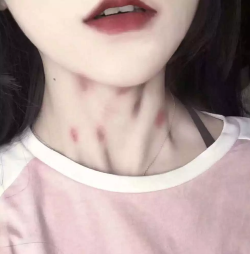 给脖子"种草莓"会致死吗?初中生"啵啵"时的禁忌,下口需谨慎!