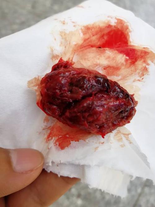 人流十天后排出肉状的东西是什么