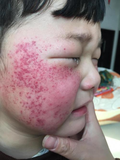 孩子呕吐过后脸上出红点