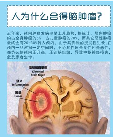 10个脑瘤早期症状千万别