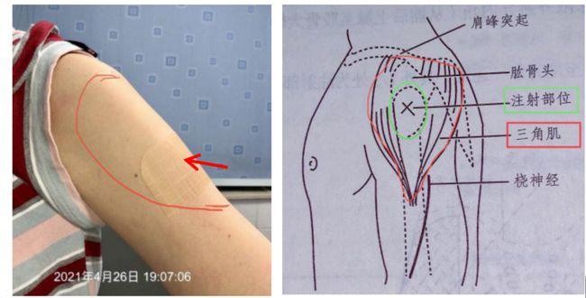 我仔细看了她的注射部位,发现注射部位有少许淡淡的瘀斑,且三角肌肌注