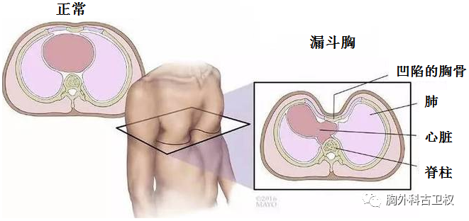 少年胸廓凹陷漏斗胸畸形,佛山市一专家微创手术解痛苦