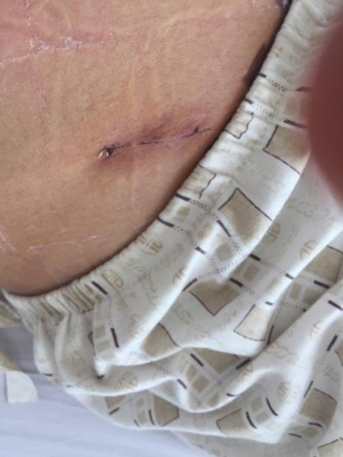 现在的阑尾炎手术的刀口就是不缝合的,大夫说是为了美观.