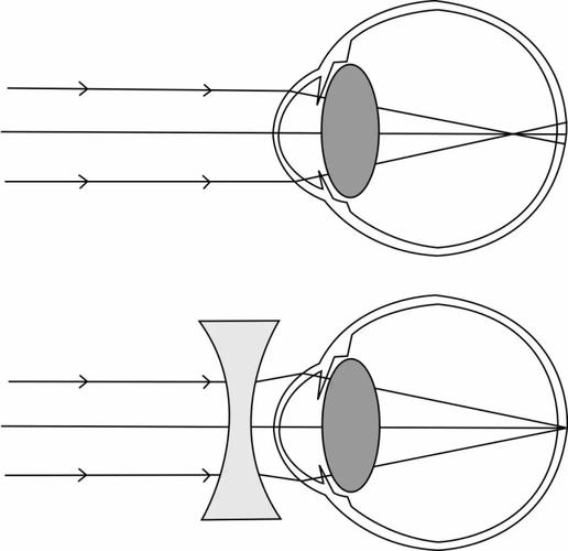 近视眼与矫正示意图
