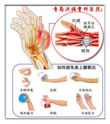 关节炎        腱鞘炎是种常见的骨科疾病,那么,什么