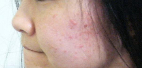 湿气重不重,一眼就看到!面部出现这一特征,要及早祛湿