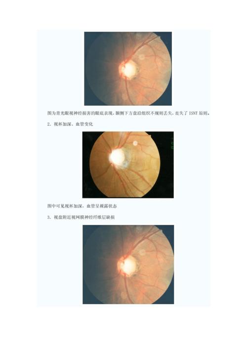 开角型青光眼的诊断和治疗.doc