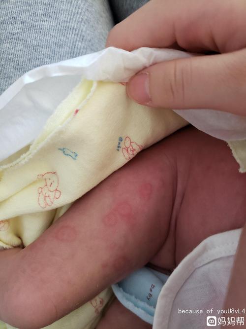 宝宝20天,前几天身上起满身红点(图一)