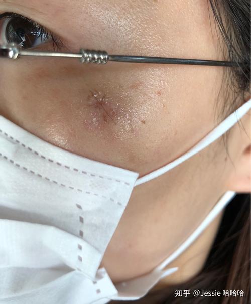 手术切除粉瘤皮脂腺囊肿是一种什么样的体验