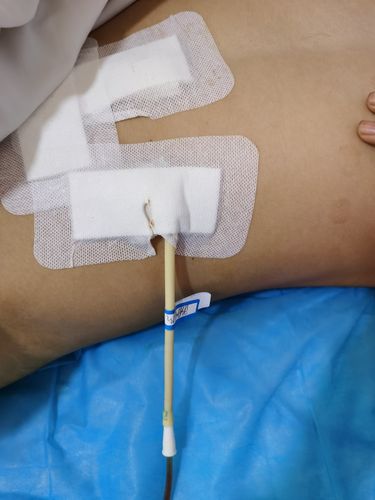 术后给以一般对症,抗炎治疗,术后一天拔除腹腔引流管,恢复顺利,术后一