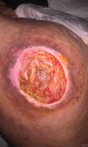 伤口溃烂生蛆图片