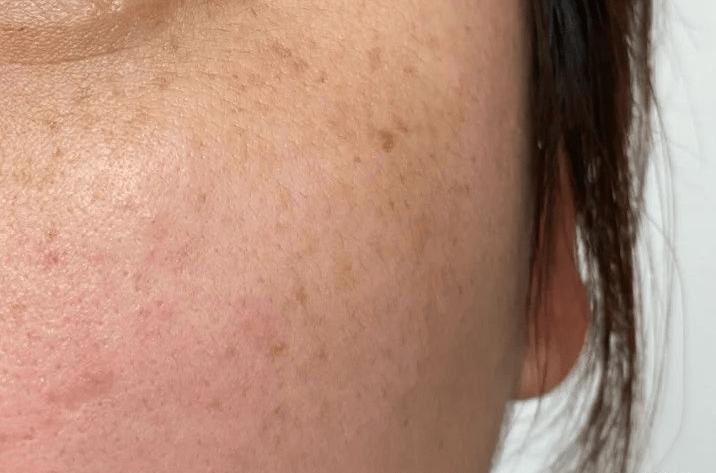 注意防晒!防止晒斑