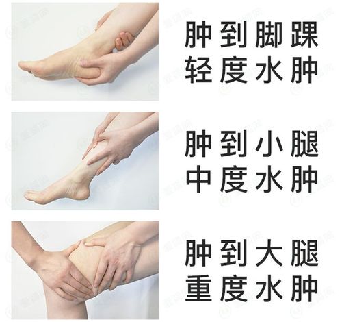 肾病水肿怎么治可能跟你想的不一样