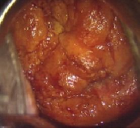 举例分析阴道镜下图像: 图中醋白上皮边缘卷曲,浓厚,稍隆起于宫颈