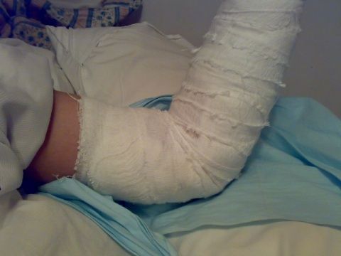 胳膊摔伤包扎_左胳膊受伤包扎图片_手臂摔伤包扎图片