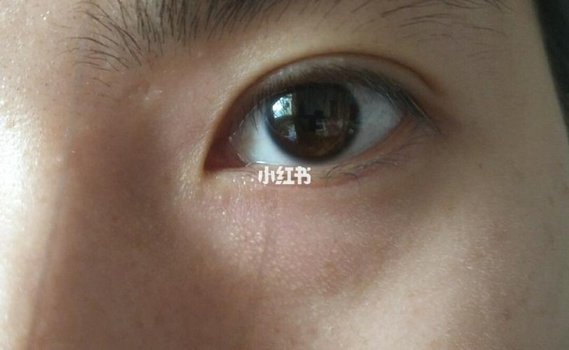 有姐妹知道眼睛下面这些小颗粒是什么吗有人说说毛周角化也有人说是