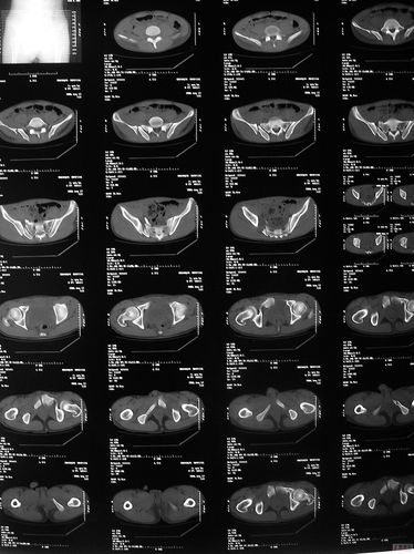 【病例讨论】骨盆骨折是否手术