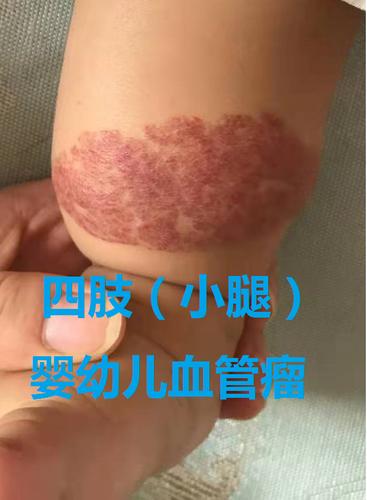 出生自带的"胎记"也可能是血管瘤!