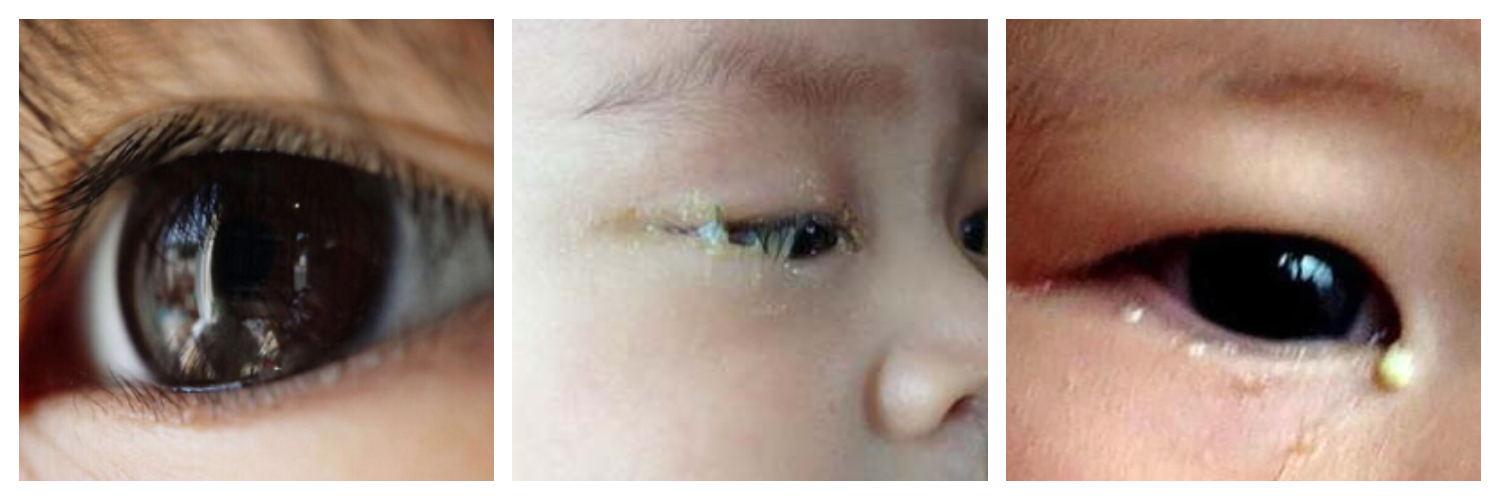 发生在出生后2周内,双侧,单侧都会发生,单侧较双侧多见,早期典型症状