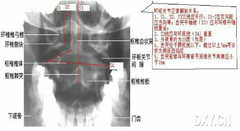 二,颈椎张口位片