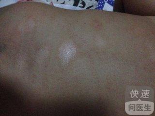 白色糠疹三个月还不好 治疗到位方能康复