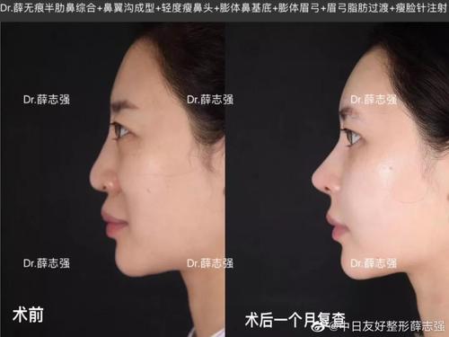 鼻基底_鼻部整形 - 好大夫在线