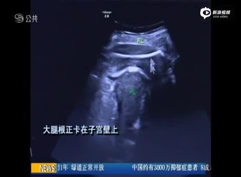 胎儿一脚踢妈妈破子宫b超照吓到医生