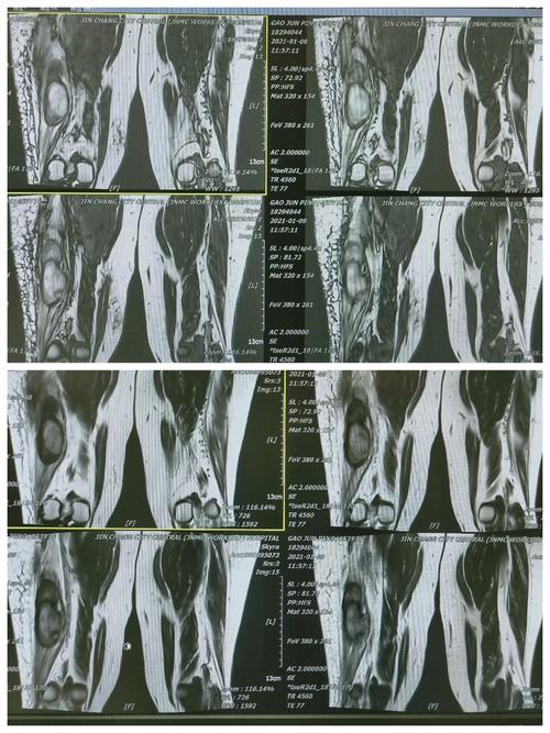 其它 下肢动脉瘤破裂出血 写美篇 彩超显示:右大腿外侧至膝关节处皮下