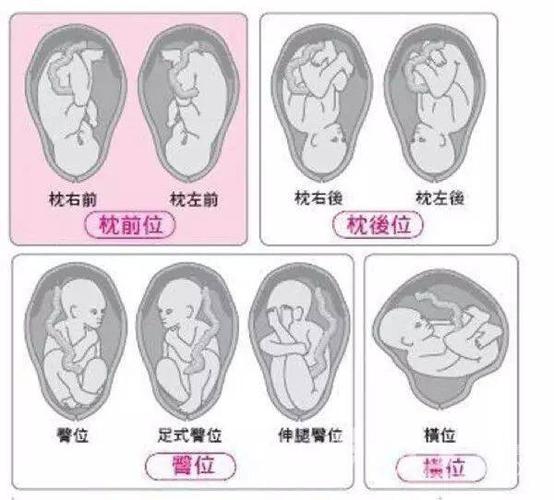 【顺产记】难顺产的头位右枕横,"巧手移位"成右枕前,实现侧卧位顺娩!