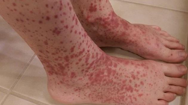 在绵阳治疗过敏性紫癜医院的好医院?