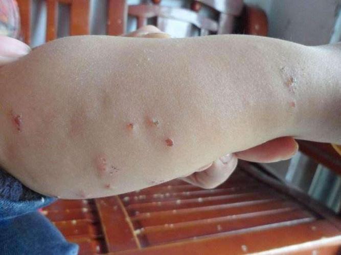 丘疹性荨麻疹,皮炎,苔藓,昆虫