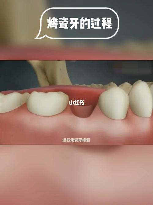 烤瓷牙的过程,一篇看懂05_烤瓷牙_美妆_医美整形