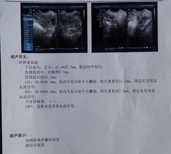 月经结束后3天的彩超显示双侧卵巢多囊状改变,月经正常,这次略有些