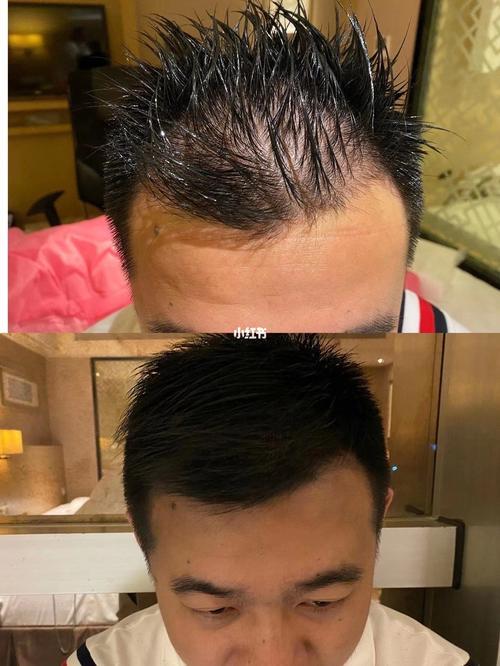 解决任何头发烦恼 高额头秃鬓角头发稀疏_生发_广州攻略_脱发_黑科技