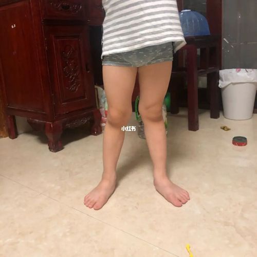 小孩四周岁足外翻x型腿要矫正吗_足外翻_小腿外翻_腿型_扁平足_腿型