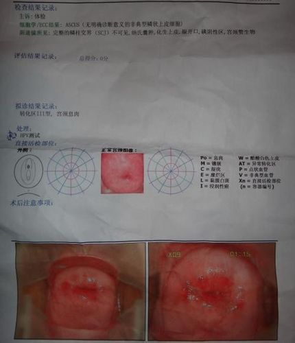 女性外阴囊肿症状