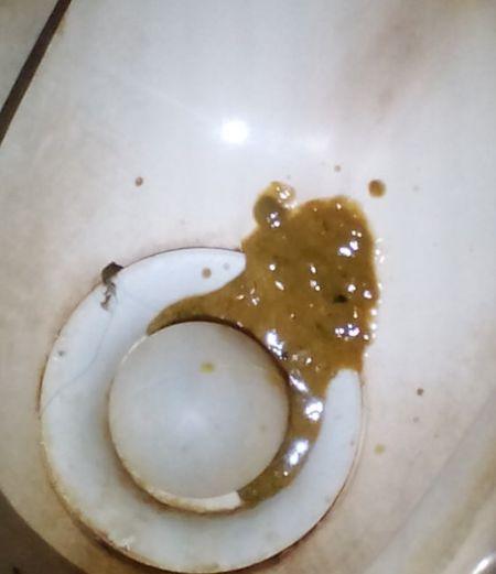 当日中午返家依然腹泻(水样大便),烧一直没退,但