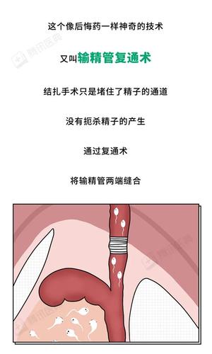 男性结扎后精子去哪儿了?对性生活有什么影响?