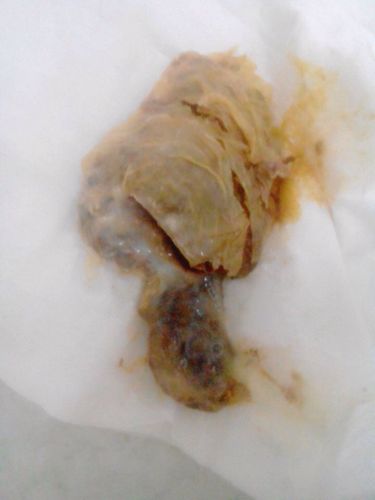 宫颈糜烂了一盒消靡栓之后三天早上上厕所流出的东西