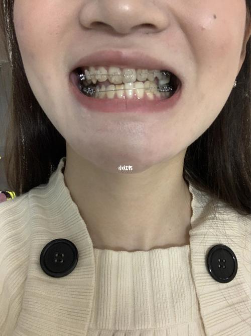 地包天矫正_牙套_面条_牙齿矫正_美妆_医美整形