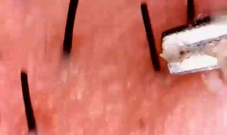 显微镜下的粉刺角栓原来是这样!简直是强迫症患者的福利!