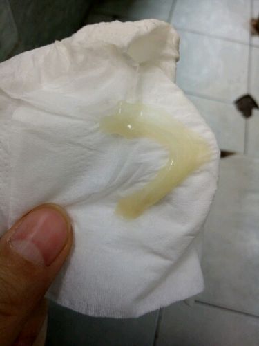 这是宫颈栓液么?有图慎入,慎入,慎入