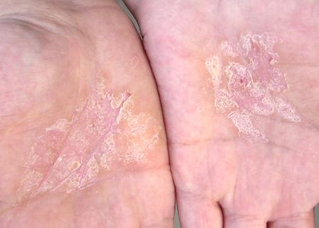 手上长癣了,脱皮,夜间有点痒,一年多了,如图,怎么办啊