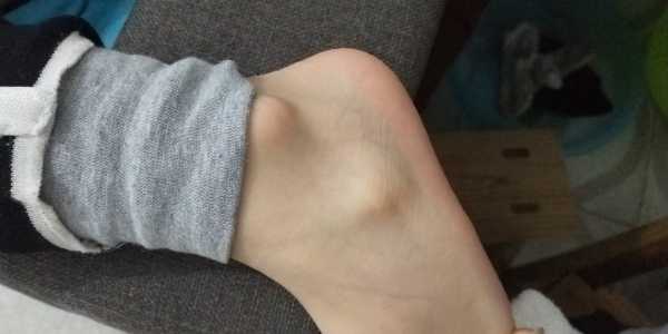 小孩脚踝旁有个突出来的骨头是怎么回事?