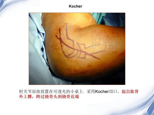 k0cher入路,桡骨小头,桡骨近端!