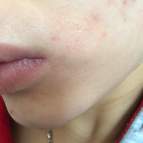 脸上!特别是嘴巴周边!干裂要掉皮一样!敷面膜还有点刺痛!