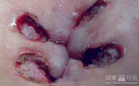 靠肉芽组织生长使伤口愈合的方法.