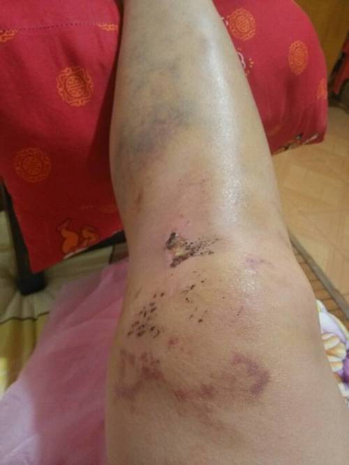 膝盖摔伤,一周了,淤青已经扩散开来了,但是膝盖任然麻木,伤口上方稍肿